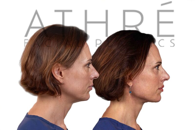 50-year-old woman shown after brow lift and facial fat grafting performed by Dr. Raghu Athré.