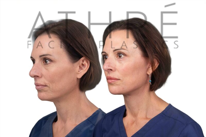Facial rejuvenation surgery including facelift and brow lift performed by Dr. Raghu Athré.