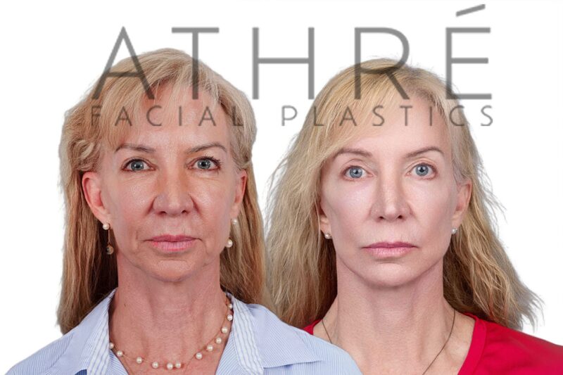 Before and after revision deep plane facelift and neck lift by Dr. Raghu Athré in 68-year-old female patient.