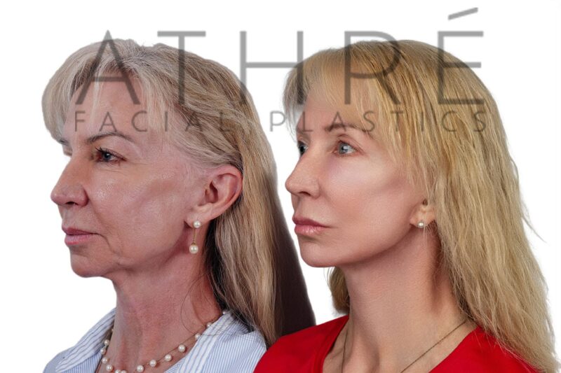 Female patient after revision 4D Facelift™, facial fat transfer, and chemical peel by Dr. Raghu Athré.