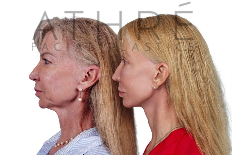 Before and after facial rejuvenation with revision facelift and stem cell treatment by Dr. Raghu Athré.