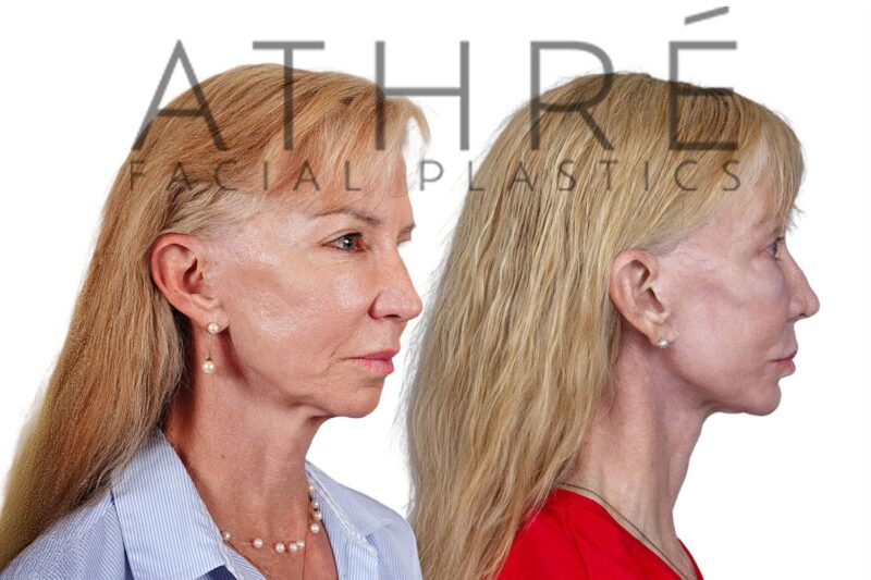 68-year-old woman shown after deep neck lift and facial fat grafting performed by Dr. Raghu Athré.