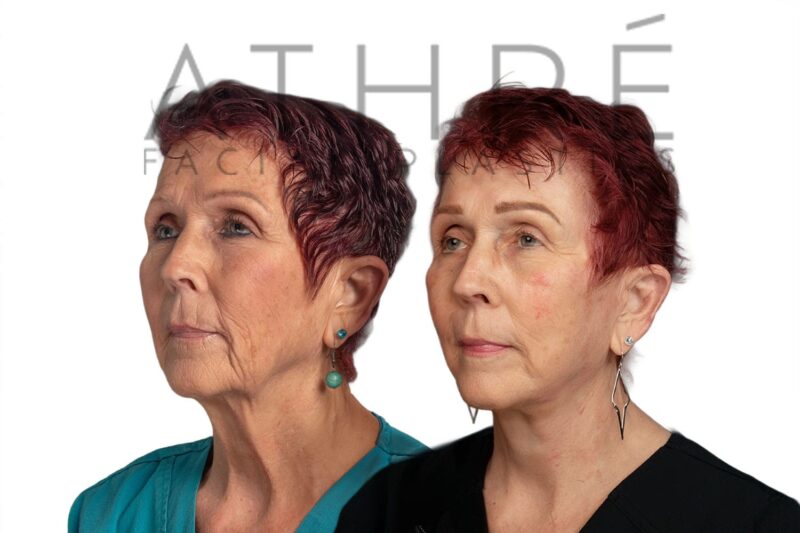Before and after deep plane facelift and neck lift by Dr. Raghu Athré in 71-year-old female patient.