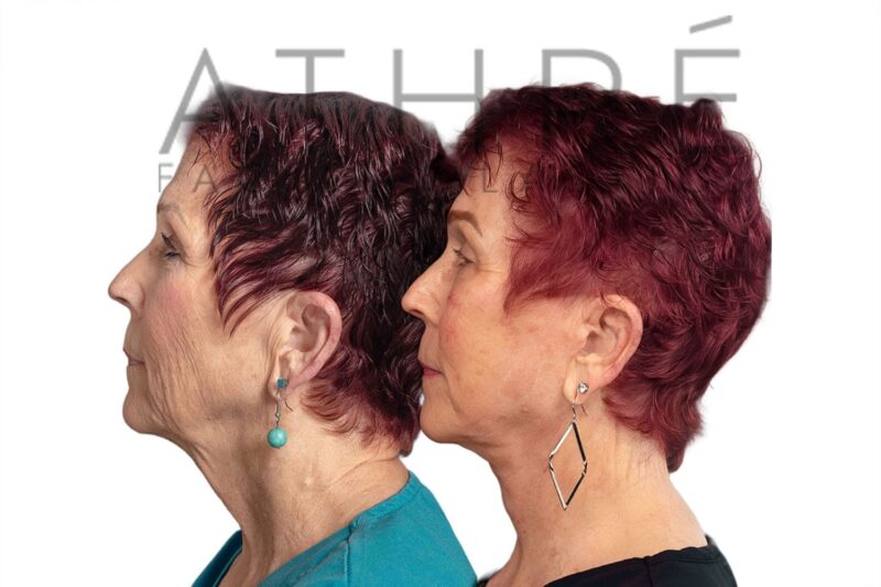 Female patient after 4D Facelift™, facial fat transfer, and chemical peel by Dr. Raghu Athré.