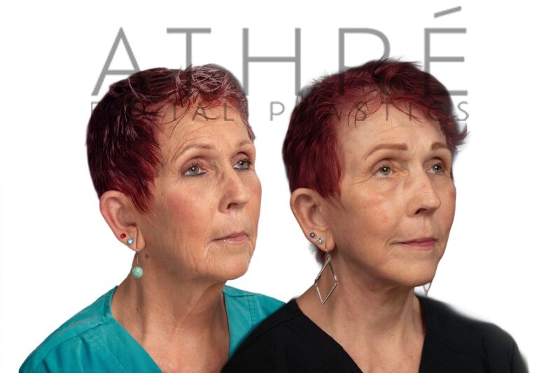 Before and after facial rejuvenation with deep plane facelift and stem cell treatment by Dr. Raghu Athré.