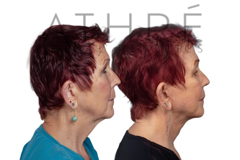 71-year-old woman shown after deep neck lift and facial resurfacing performed by Dr. Raghu Athré.
