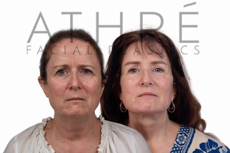 Before and after deep plane facelift, brow lift, and upper blepharoplasty by Dr. Raghu Athré in female patient.