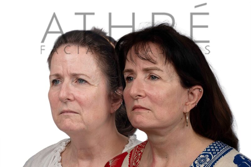 Female patient after 4D Facelift™, facial fat transfer, and neck lift by Dr. Raghu Athré.
