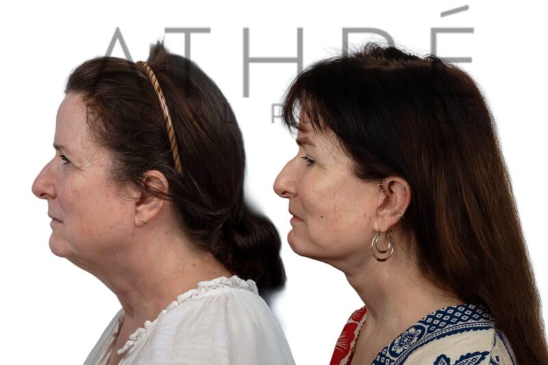 Before and after facial rejuvenation with facelift and chemical peel by Dr. Raghu Athré.