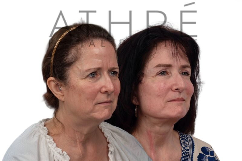 Female patient shown after brow lift and stem cell facial treatment performed by Dr. Raghu Athré.
