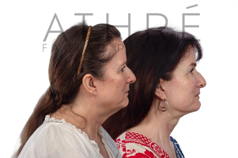 Facial rejuvenation surgery including facelift and upper eyelid surgery performed by Dr. Raghu Athré.