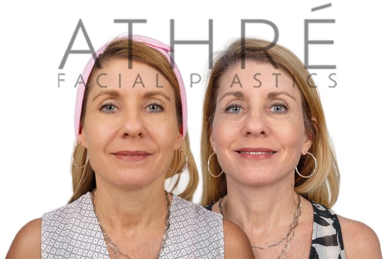 Before and after deep plane facelift and lower eyelid blepharoplasty by Dr. Raghu Athré in 57-year-old female patient.