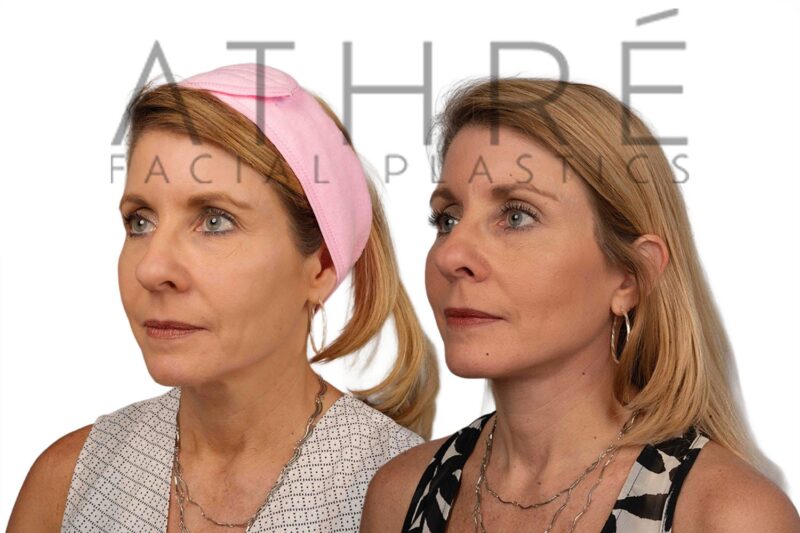 Female patient after 4D Facelift™, lip augmentation with fat, and neck lift by Dr. Raghu Athré.