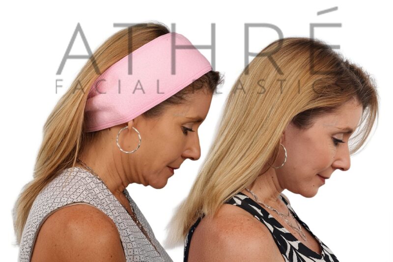 Facial rejuvenation surgery including facelift and subciliary blepharoplasty performed by Dr. Raghu Athré.