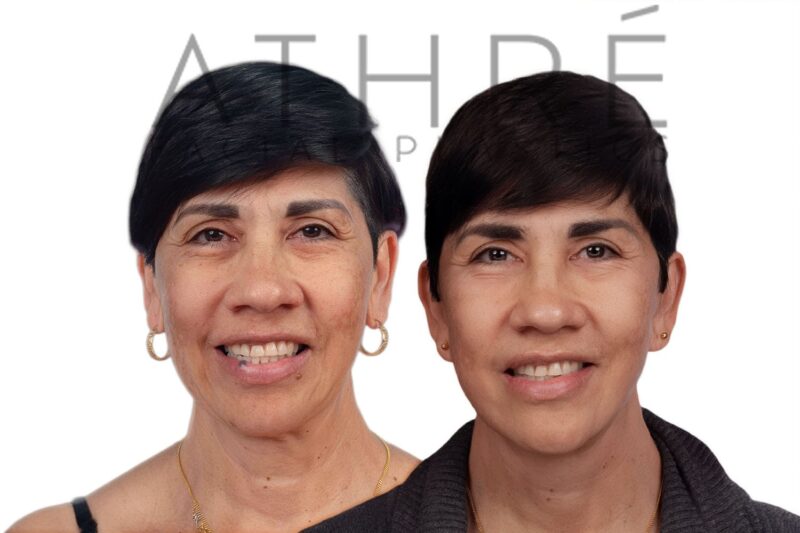 Before and after deep plane facelift, brow lift, and upper blepharoplasty by Dr. Raghu Athré in 60-year-old female patient.