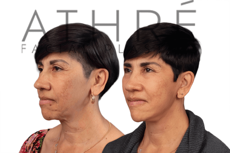 Female patient after 4D Facelift™, facial fat transfer, and neck lift by Dr. Raghu Athré.