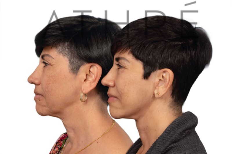 Before and after facial rejuvenation with facelift and nanofat stem cell treatment by Dr. Raghu Athré.