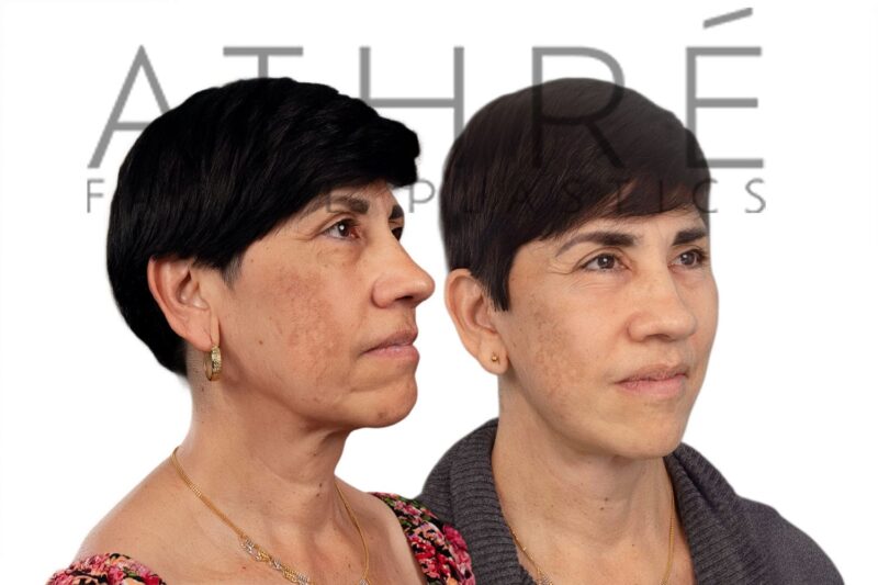 60-year-old woman shown after brow lift and facial fat grafting performed by Dr. Raghu Athré.