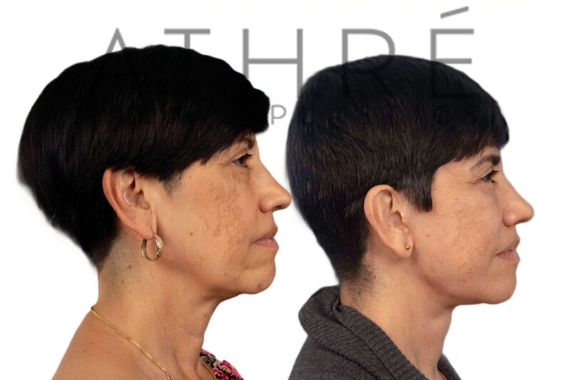 Facial rejuvenation surgery including facelift and upper eyelid surgery performed by Dr. Raghu Athré.