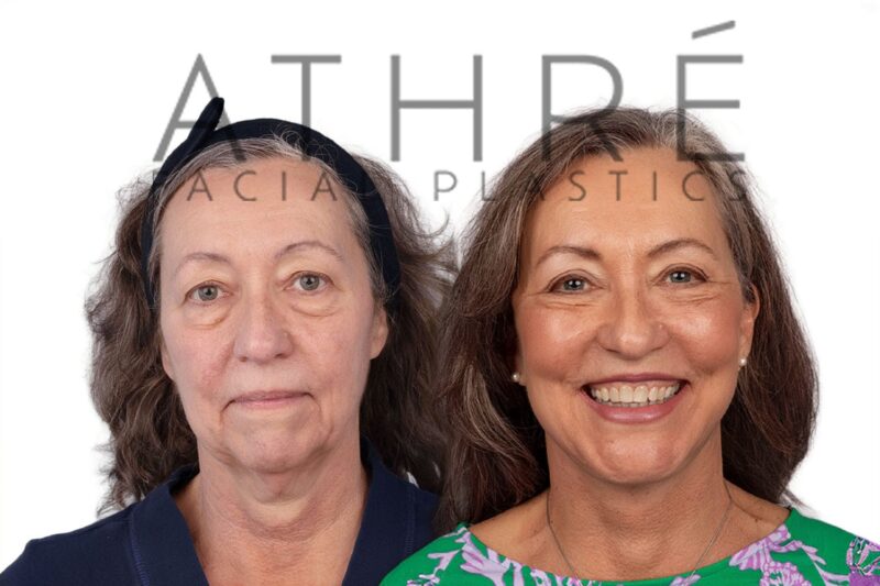 Before and after deep plane facelift, chin augmentation, and blepharoplasty by Dr. Raghu Athré in 66-year-old female patient.