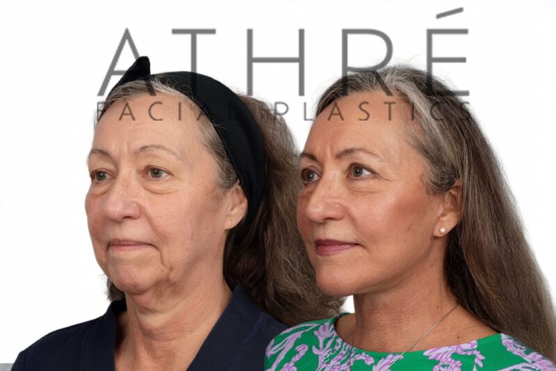 Female patient after 4D Facelift™, deep neck lift, and facial fat transfer by Dr. Raghu Athré.