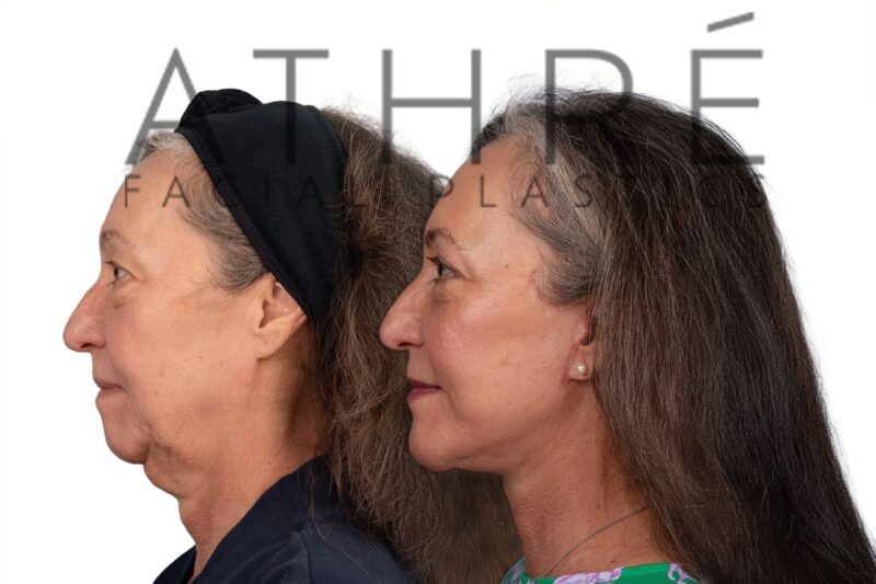 Before and after facial rejuvenation with facelift and subciliary lower blepharoplasty by Dr. Raghu Athré.