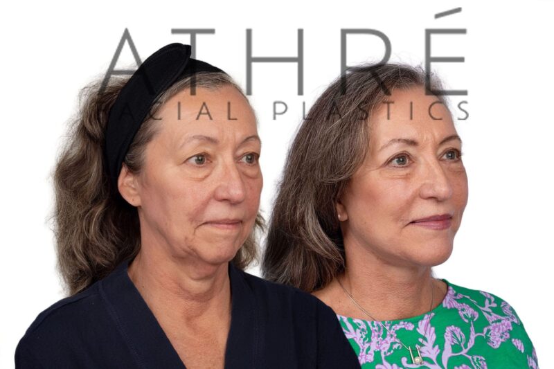 66-year-old woman shown after chin augmentation and stem cell nanofat treatment performed by Dr. Raghu Athré.