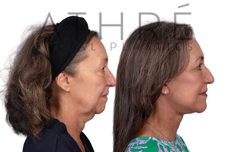 Facial rejuvenation surgery including facelift and upper eyelid surgery performed by Dr. Raghu Athré.