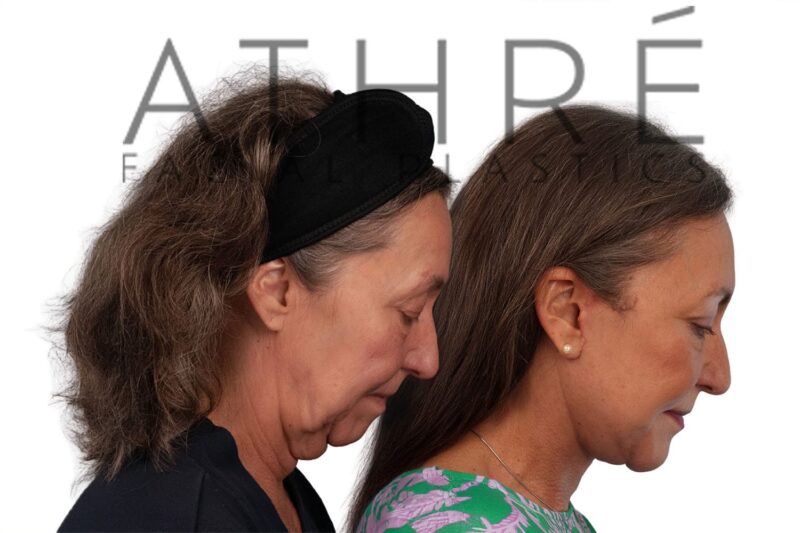 Before and after 4D Facelift™, chin augmentation, and lower blepharoplasty by Dr. Raghu Athré in 66-year-old female patient.
