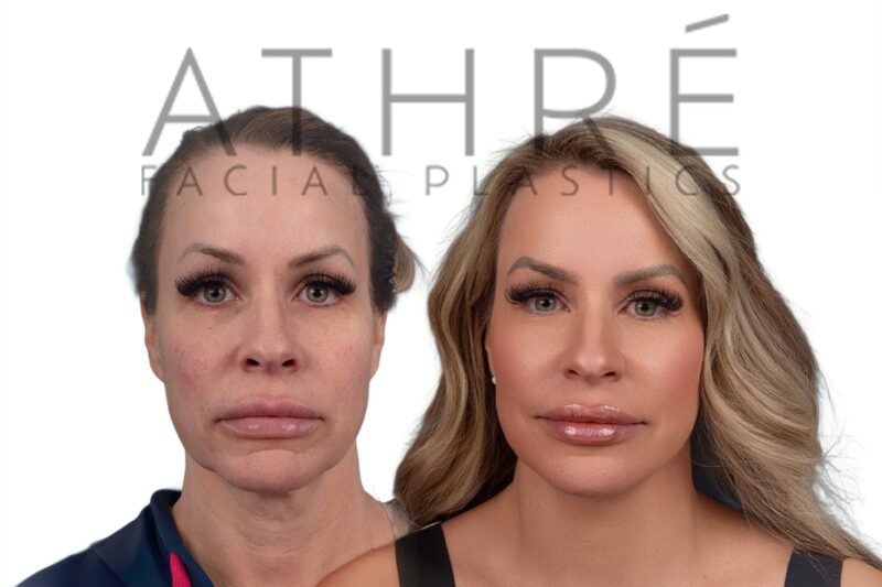 Before and after deep plane facelift and neck lift by Dr. Raghu Athré in 53-year-old female patient.