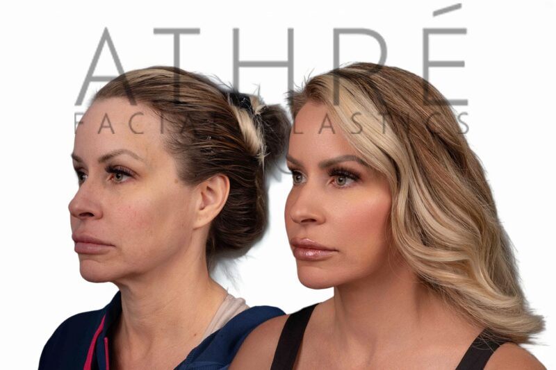 Female patient after 4D Facelift™, facial fat transfer, and stem cell nanofat treatment by Dr. Raghu Athré.