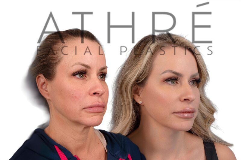 53-year-old woman shown after deep neck lift and facial fat grafting performed by Dr. Raghu Athré.