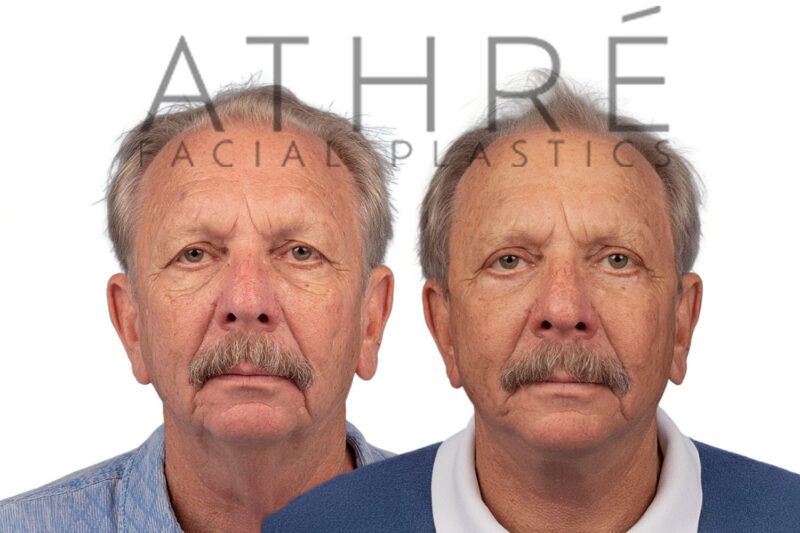 Before and after deep plane facelift and blepharoplasty by Dr. Raghu Athré in 72-year-old male patient.