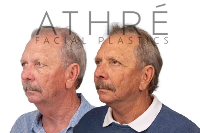 Male patient after 4D Facelift™, deep neck lift, and facial fat transfer by Dr. Raghu Athré.