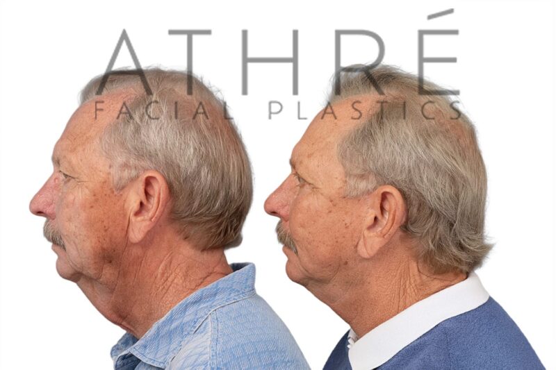 Before and after facial rejuvenation with facelift and subciliary lower blepharoplasty by Dr. Raghu Athré.