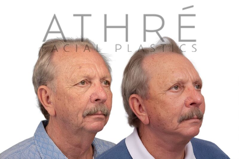 72-year-old man shown after upper eyelid surgery and stem cell nanofat treatment performed by Dr. Raghu Athré.