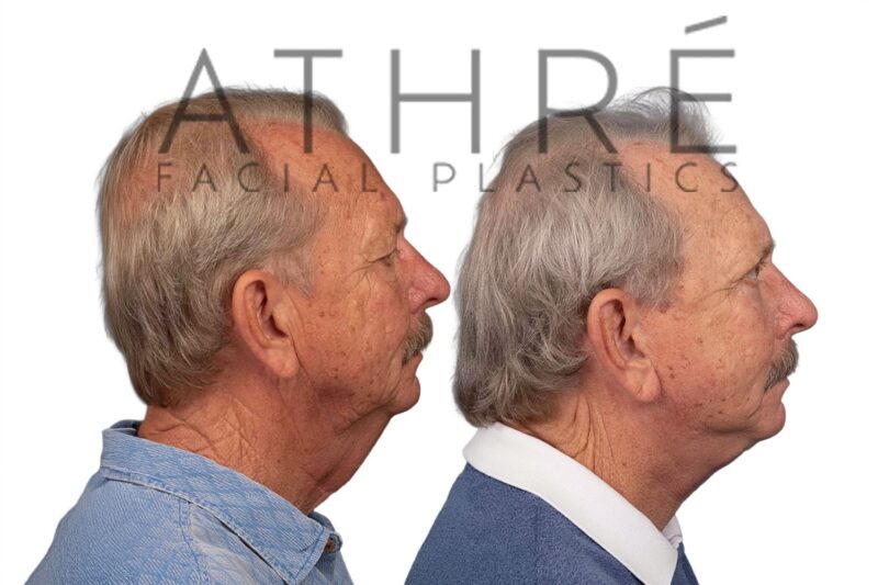 Facial rejuvenation surgery including facelift and blepharoplasty performed by Dr. Raghu Athré.