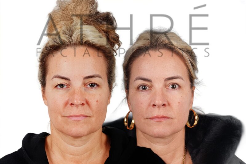 Before and after deep plane facelift and upper blepharoplasty by Dr. Raghu Athré in 51-year-old female patient.