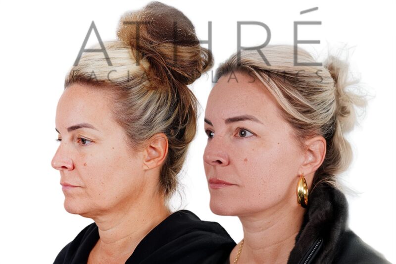 Female patient after 4D Facelift™, deep neck lift, and facial fat transfer by Dr. Raghu Athré.