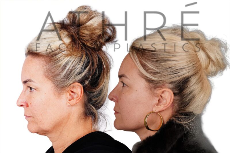 Before and after facial rejuvenation with facelift and lip augmentation by Dr. Raghu Athré.