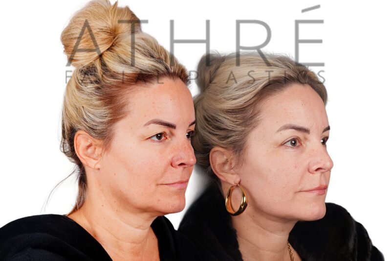 51-year-old woman shown after upper eyelid surgery and stem cell nanofat treatment performed by Dr. Raghu Athré.