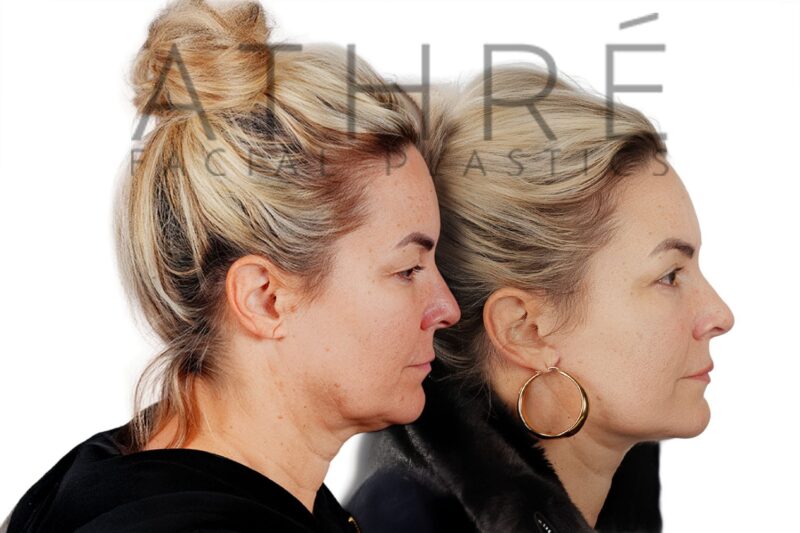 Facial rejuvenation surgery including facelift and blepharoplasty performed by Dr. Raghu Athré.