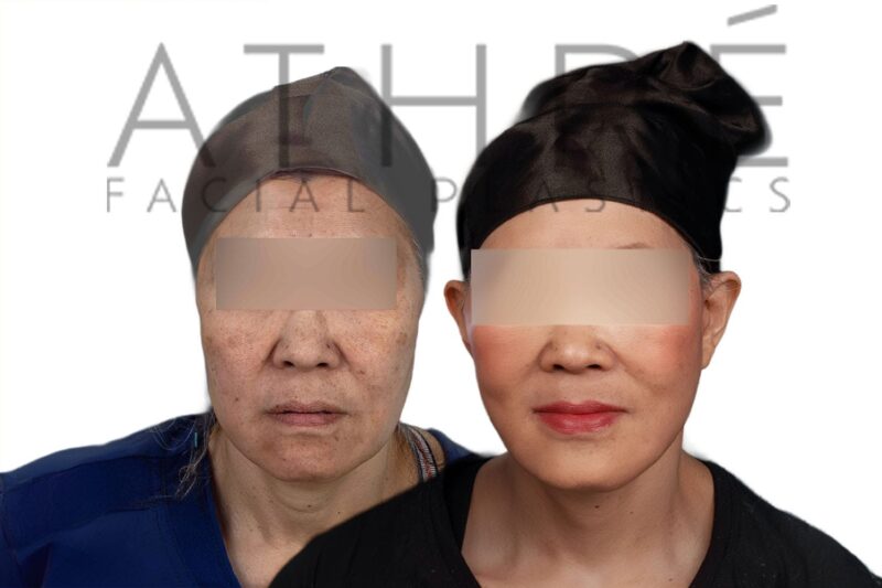 Before and after deep plane facelift and blepharoplasty by Dr. Raghu Athré in 61-year-old female patient.