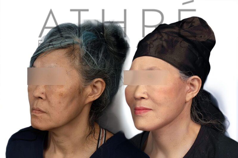 Female patient after 4D Facelift™, deep neck lift, and facial fat transfer by Dr. Raghu Athré.