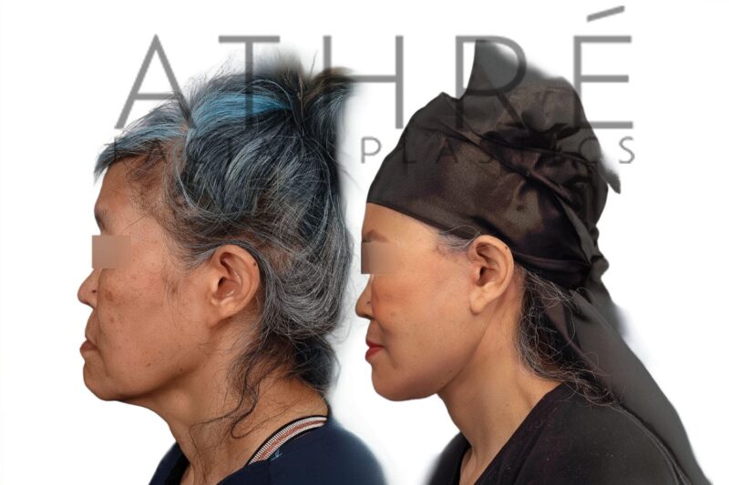 Before and after facial rejuvenation with facelift and subciliary lower blepharoplasty by Dr. Raghu Athré.