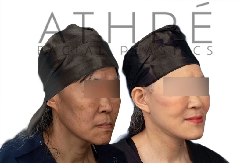 61-year-old woman shown after upper eyelid surgery and stem cell nanofat treatment performed by Dr. Raghu Athré.