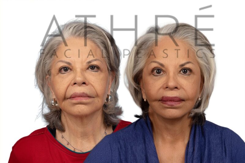 Before and after revision deep plane facelift and neck lift by Dr. Raghu Athré in 66-year-old female patient.
