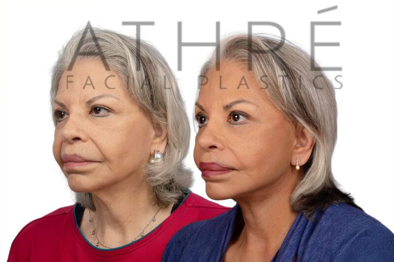 Female patient after revision 4D Facelift™, facial fat transfer, and stem cell nanofat treatment by Dr. Raghu Athré.