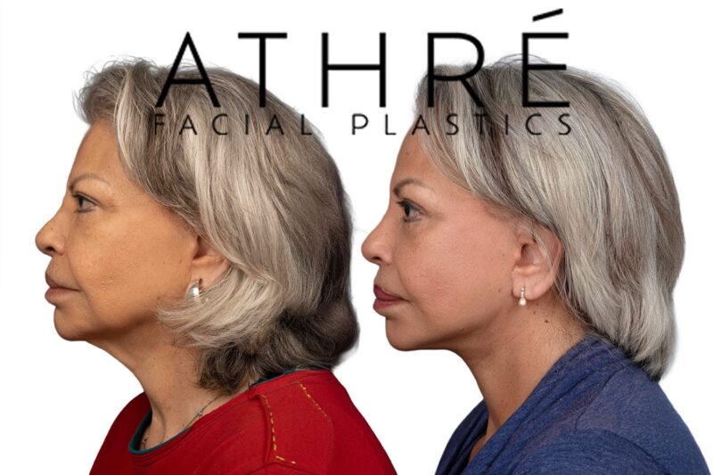 Before and after facial rejuvenation with revision facelift by Dr. Raghu Athré.