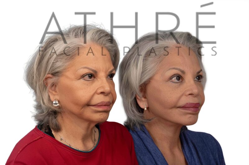 66-year-old woman shown after deep neck lift and facial fat grafting performed by Dr. Raghu Athré.